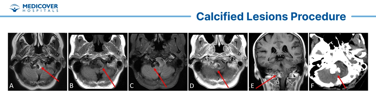Calcified lesions